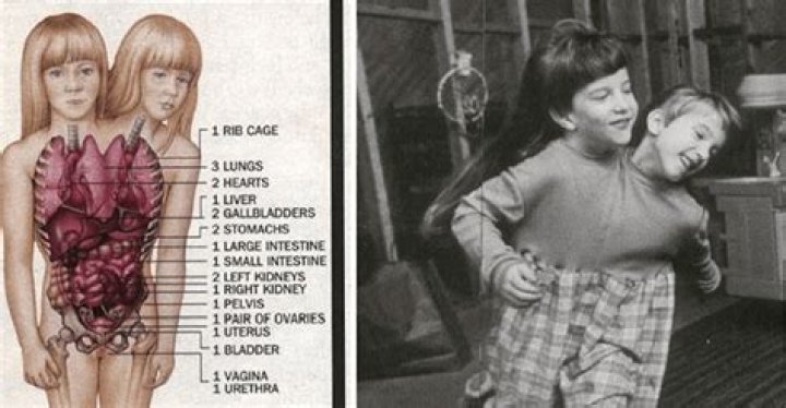 Tragic Loss: The Inspiring Lives And Deaths Of Abby And Brittany Hensel