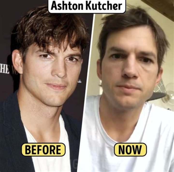 Ashton Kutcher's Plastic Surgery Journey