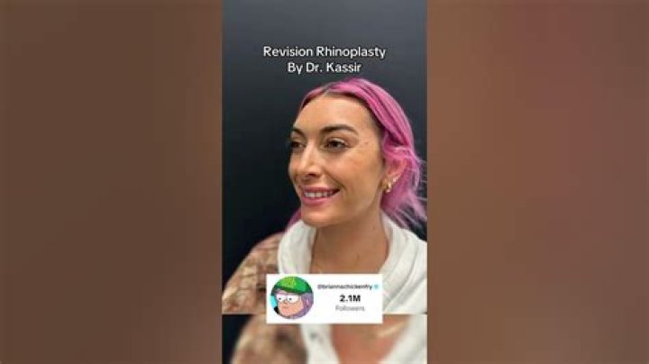 Brianna Chickenfry's Nose Job Unveiled