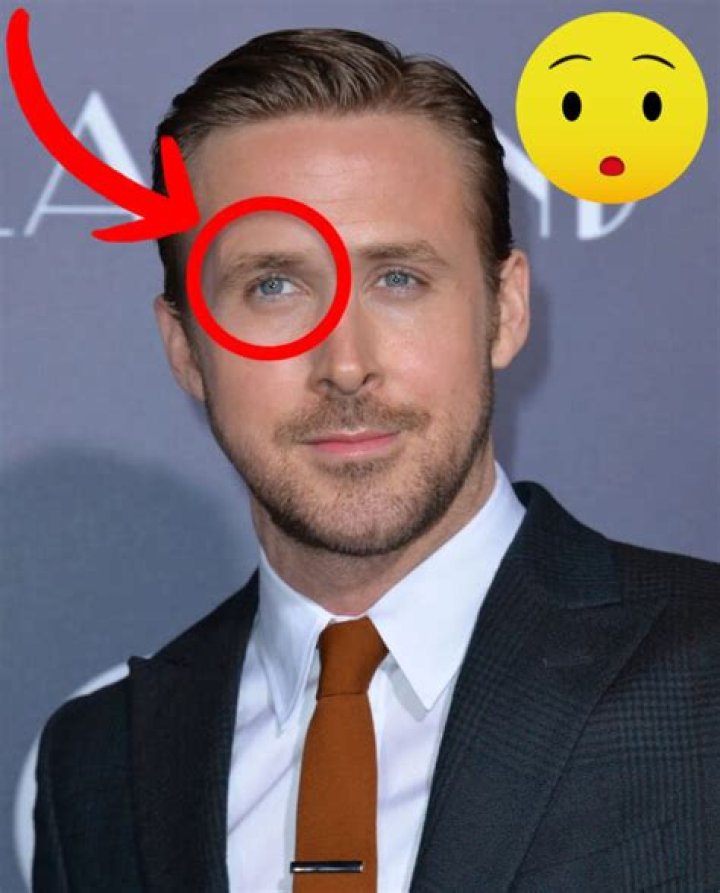 Eye-Catching Celebrities With Lazy Eye