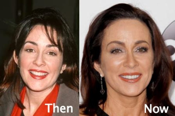 Has Patricia Heaton Had Plastic Surgery? Findings And Expert Opinions