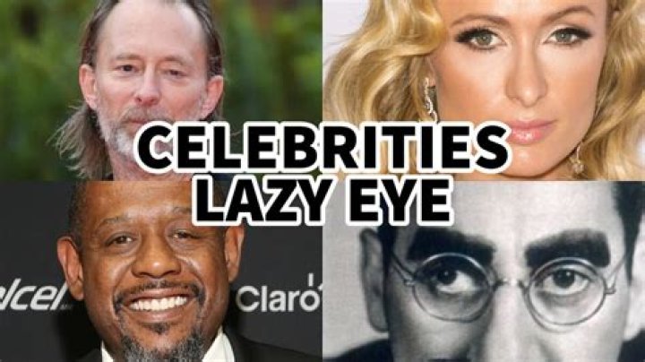 Uncover The Famous Faces Hidden Behind A Lazy Eye
