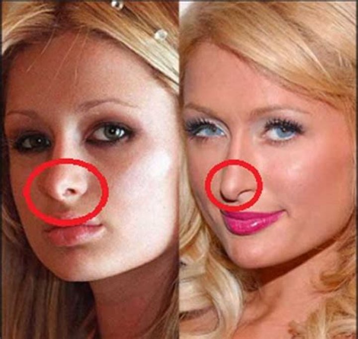 Paris Hilton's Nose: Exploring The Evolution Of Her Signature Feature