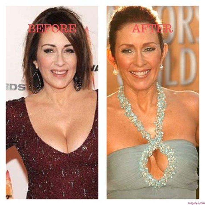 Patricia Heaton's Plastic Surgery: Before And After Photos And Details