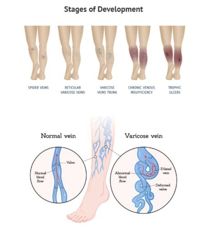 ICD-10 Code For Recurrent Deep Vein Thrombosis (DVT): Your Guide