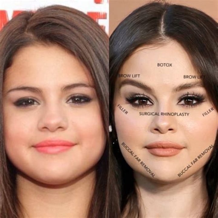 How Selena Gomez Transformed Her Look Before Surgery